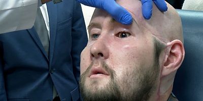 Bilim insanları bunu da başardı: Dünyanın ilk tüm göz nakli gerçekleştirildi